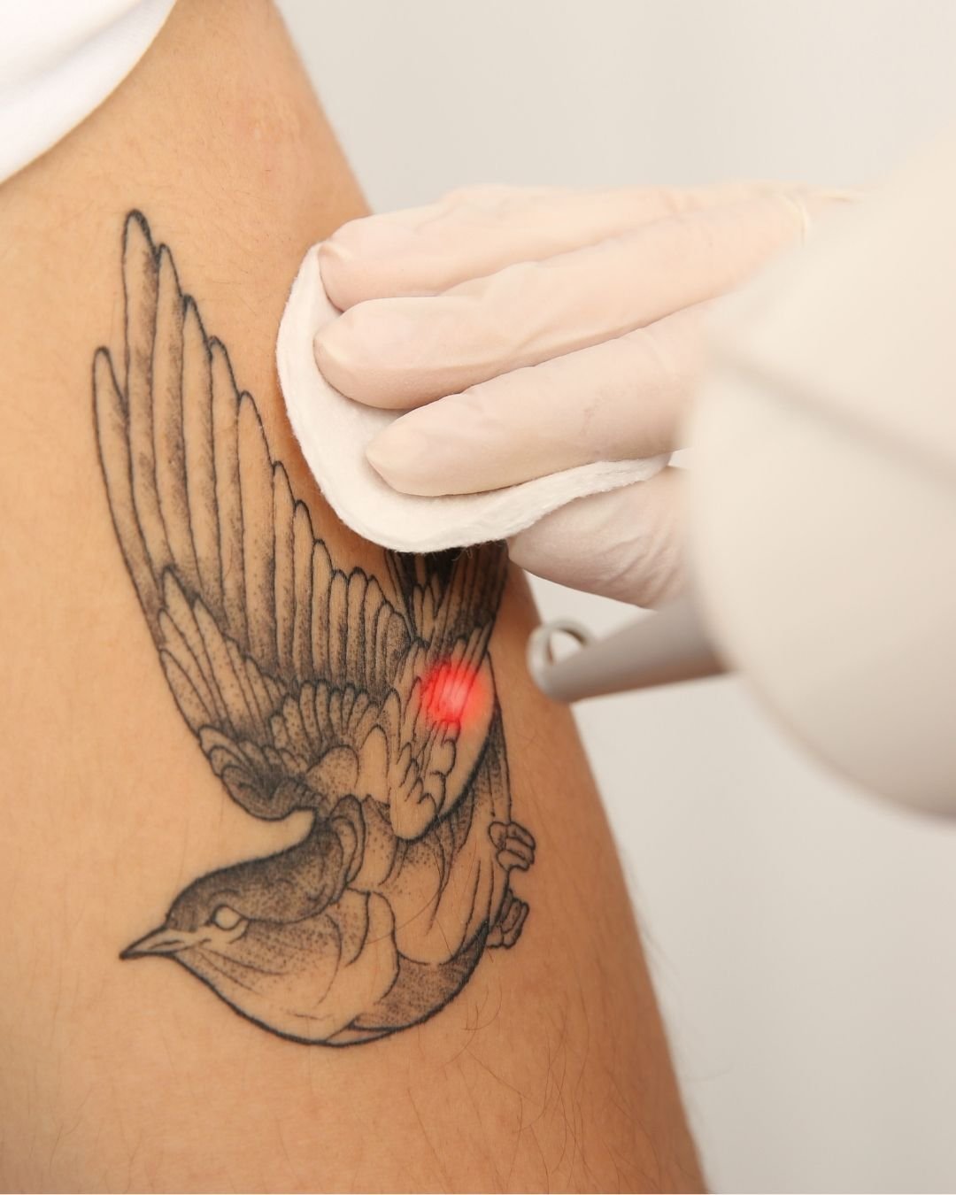Eliminación de Tatuajes